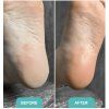 Foot Callus Softening Foam Soft Blade Shelly 150 ml